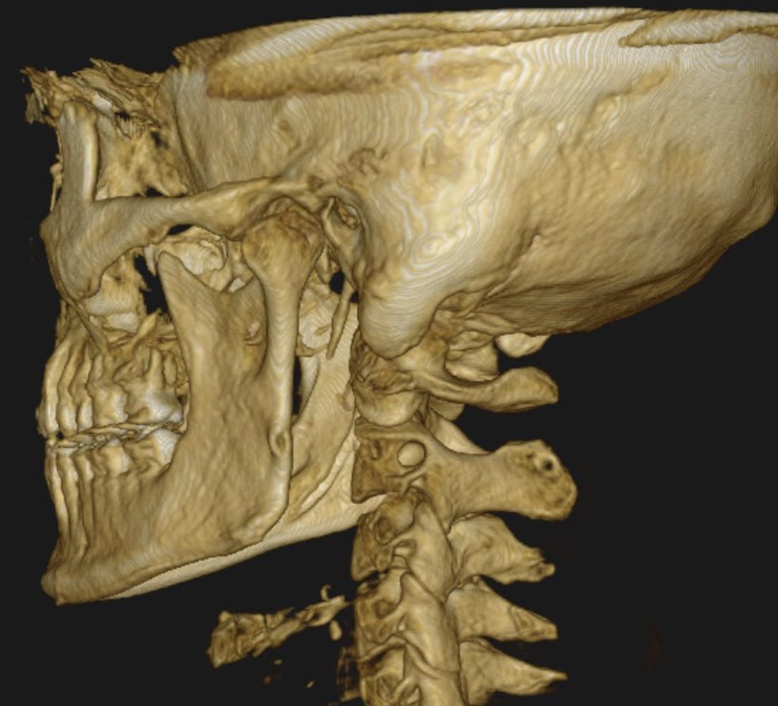 3D CBCT scan of a patient's skull and upper neck
