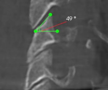 Close-up CBCT image with the angle of an upper neck joint measured at 49 degrees